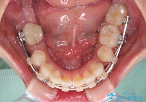 膨らんだ口元を改善する抜歯矯正 インプラント治療も同時に行う総合歯科治療の治療中