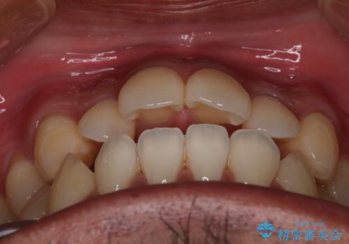 【審美装置】開口(オープンバイト)を改善の治療前