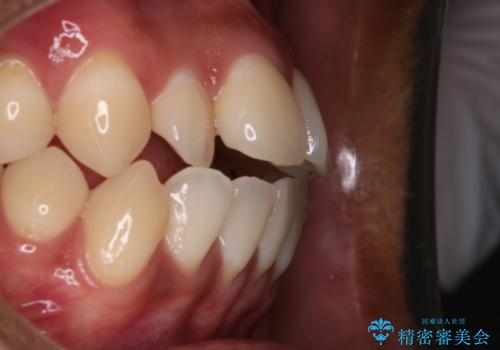 【審美装置】開口(オープンバイト)を改善の治療前