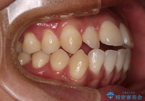 【審美装置】開口(オープンバイト)を改善の治療前