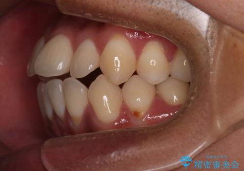 【審美装置】開口(オープンバイト)を改善の治療前