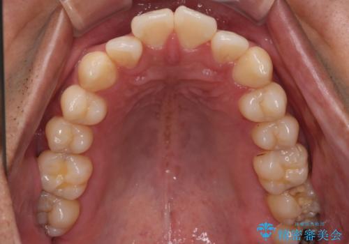 【審美装置】開口(オープンバイト)を改善の治療前