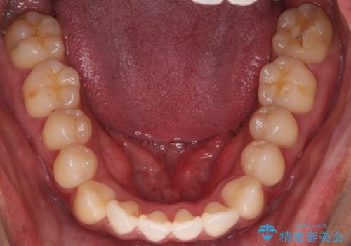 【審美装置】開口(オープンバイト)を改善の治療前