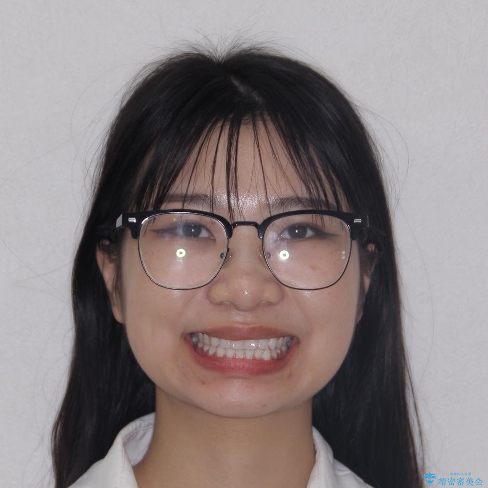 【モニター】マウスピース矯正が煩わしい ワイヤー装置での非抜歯矯正の治療前(顔貌)