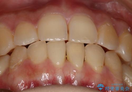 下の前歯のガタつきを治したい インビザライン・ライトパッケージの治療後