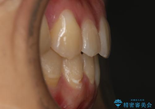 下の前歯のガタつきを治したい インビザライン・ライトパッケージの治療後