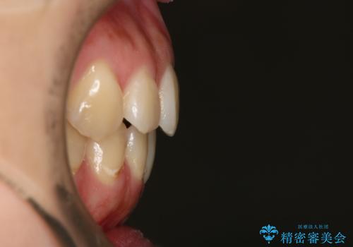下の前歯のガタつきを治したい インビザライン・ライトパッケージの治療前