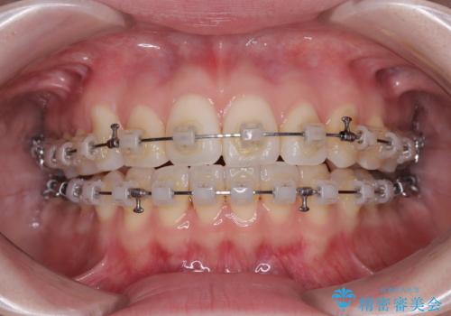 前歯のデコボコと口元の膨らみを治したい ワイヤー装置での非抜歯矯正の治療中