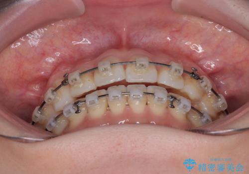 前歯のデコボコと口元の膨らみを治したい ワイヤー装置での非抜歯矯正の治療中