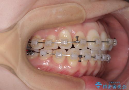 前歯のデコボコと口元の膨らみを治したい ワイヤー装置での非抜歯矯正の治療中