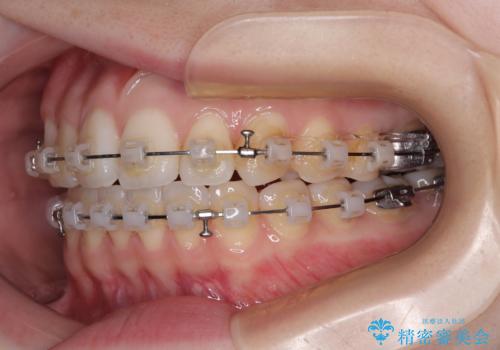 前歯のデコボコと口元の膨らみを治したい ワイヤー装置での非抜歯矯正の治療中