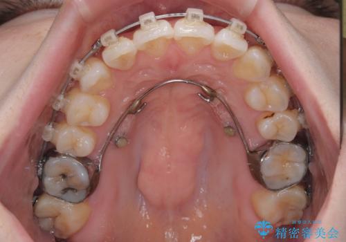 前歯のデコボコと口元の膨らみを治したい ワイヤー装置での非抜歯矯正の治療中