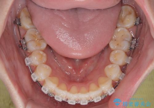 前歯のデコボコと口元の膨らみを治したい ワイヤー装置での非抜歯矯正の治療中