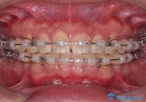 隙間だらけの歯列を治したい ワイヤー矯正での矯正治療の治療中
