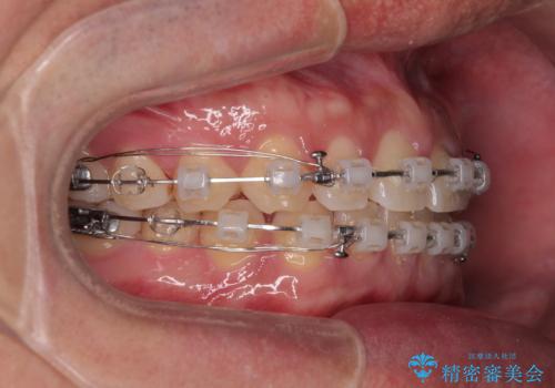 隙間だらけの歯列を治したい ワイヤー矯正での矯正治療の治療中
