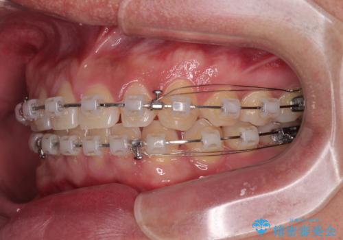 隙間だらけの歯列を治したい ワイヤー矯正での矯正治療の治療中