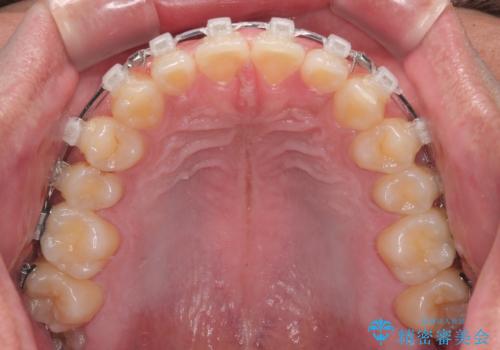 隙間だらけの歯列を治したい ワイヤー矯正での矯正治療の治療中