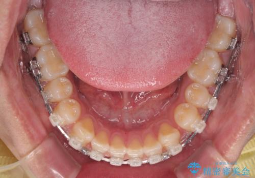 隙間だらけの歯列を治したい ワイヤー矯正での矯正治療の治療中