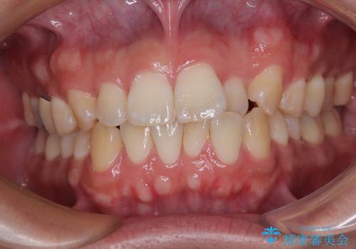 前歯のデコボコをささっと治す 短期間でのインビザライン矯正治療の症例 治療前