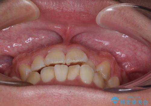 前歯のデコボコをささっと治す 短期間でのインビザライン矯正治療の治療前