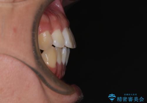 前歯のデコボコをささっと治す 短期間でのインビザライン矯正治療の治療前