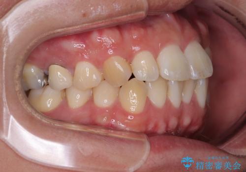 前歯のデコボコをささっと治す　短期間でのインビザライン矯正治療の治療前