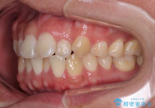 前歯のデコボコをささっと治す 短期間でのインビザライン矯正治療の治療前