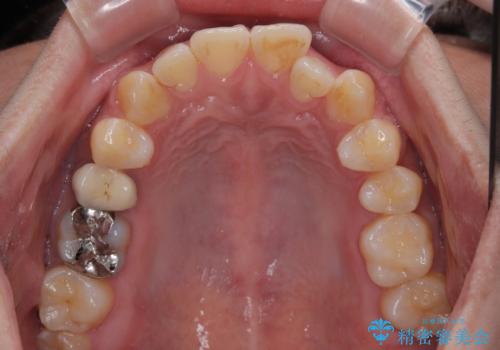 前歯のデコボコをささっと治す 短期間でのインビザライン矯正治療の治療前
