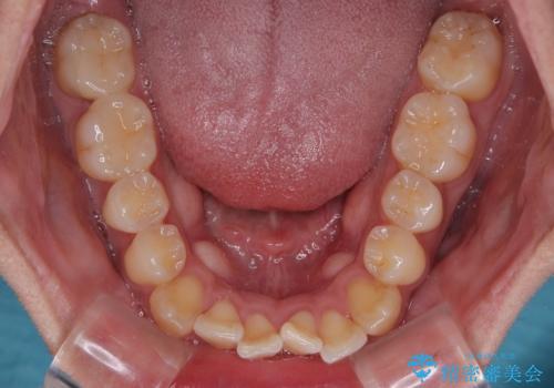 前歯のデコボコをささっと治す 短期間でのインビザライン矯正治療の治療前