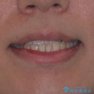 前歯のデコボコをささっと治す 短期間でのインビザライン矯正治療の治療前(顔貌)