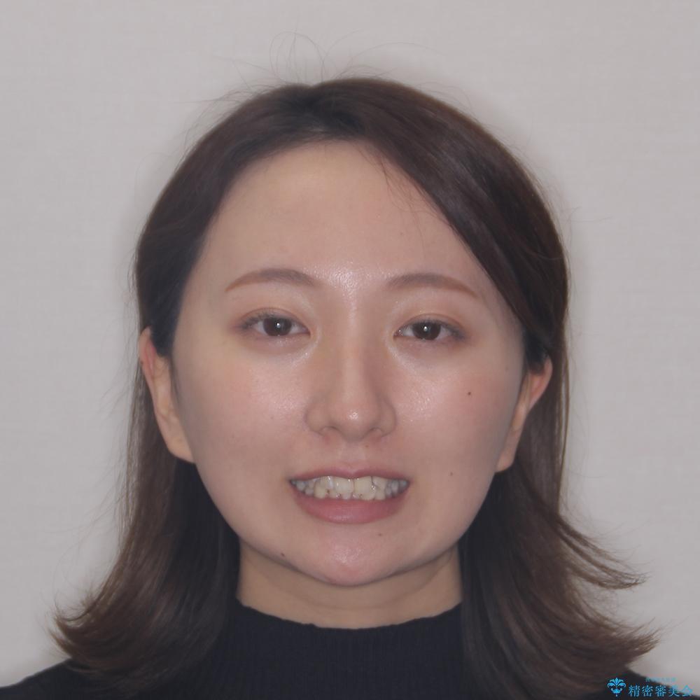 【モニター】前歯のデコボコをワイヤーの抜歯矯正で綺麗に整えるの治療前(顔貌)