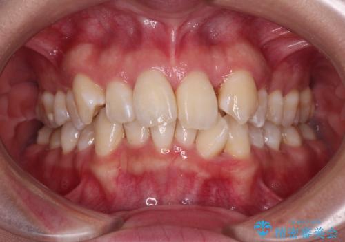 【モニター】前歯のデコボコをワイヤーの抜歯矯正で綺麗に整えるの症例 治療前