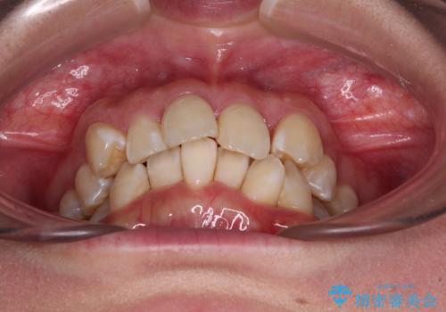 【モニター】前歯のデコボコをワイヤーの抜歯矯正で綺麗に整えるの治療前