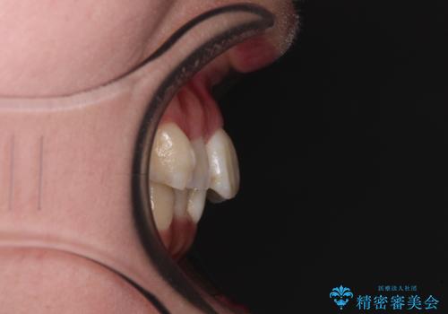 【モニター】前歯のデコボコをワイヤーの抜歯矯正で綺麗に整えるの治療前