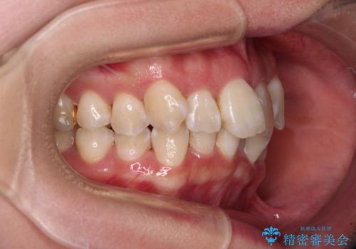 【モニター】前歯のデコボコをワイヤーの抜歯矯正で綺麗に整えるの治療前