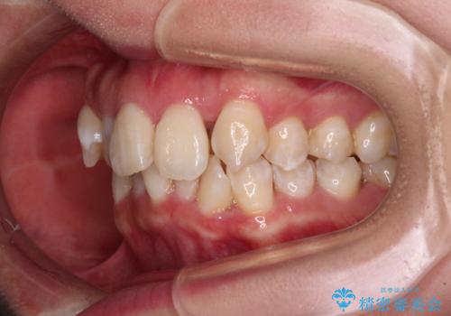 【モニター】前歯のデコボコをワイヤーの抜歯矯正で綺麗に整えるの治療前