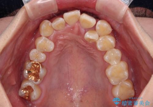 【モニター】前歯のデコボコをワイヤーの抜歯矯正で綺麗に整えるの治療前