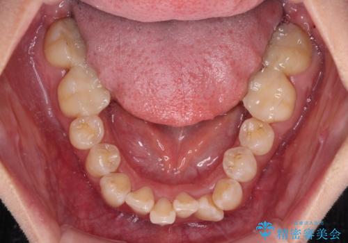 【モニター】前歯のデコボコをワイヤーの抜歯矯正で綺麗に整えるの治療前