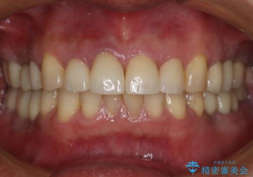 前歯の被せ物をリニューアルの治療後