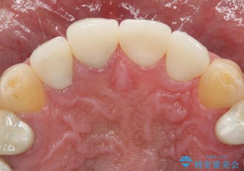 前歯の被せ物をリニューアルの治療後