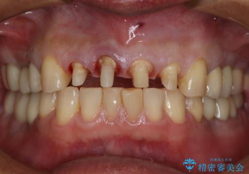 前歯の被せ物をリニューアルの治療中