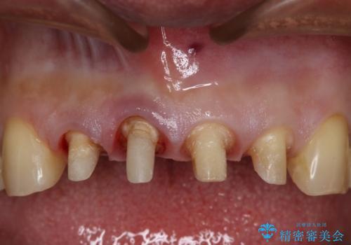 前歯の被せ物をリニューアルの治療中