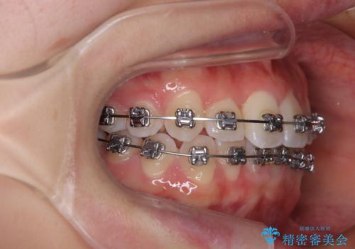 前歯のクロスバイト 裏側に隠れた歯をワイヤー装置で短期間治療の治療中