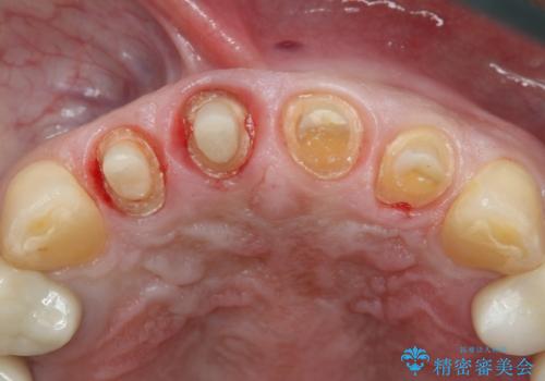 前歯の被せ物をリニューアルの治療中