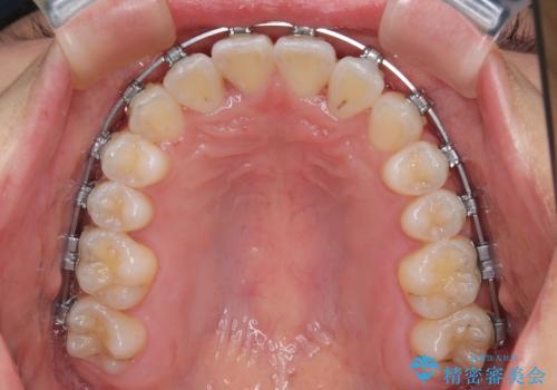 前歯のクロスバイト 裏側に隠れた歯をワイヤー装置で短期間治療の治療中