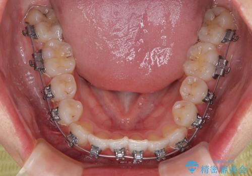 前歯のクロスバイト 裏側に隠れた歯をワイヤー装置で短期間治療の治療中