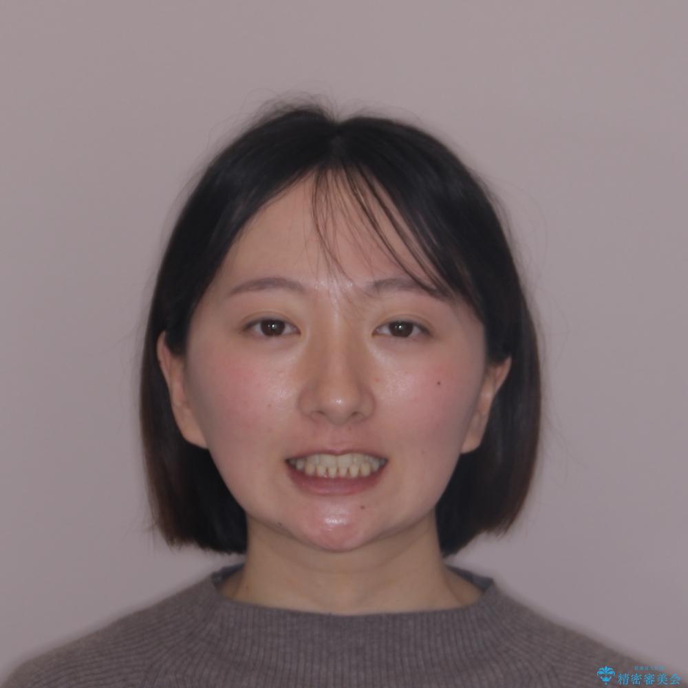 【モニター】前歯のデコボコをワイヤーの抜歯矯正で綺麗に整えるの治療後(顔貌)