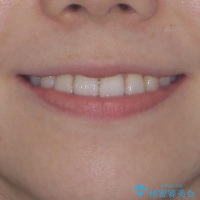 前歯のデコボコと口元の膨らみを治したい ワイヤー装置での非抜歯矯正の治療後(顔貌)