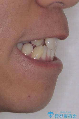 八重歯と前歯のガタガタを抜歯矯正で治療|クリアブラケット使用例の治療前(顔貌)