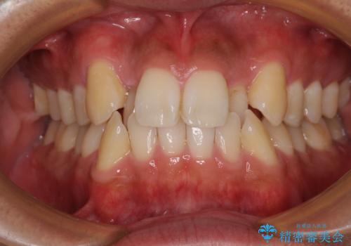 八重歯と前歯のガタガタを抜歯矯正で治療|クリアブラケット使用例の症例 治療前